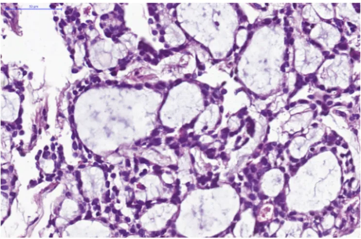 Fig. 2. Tubules and cribriform nests of basaloid cells lining cystic spaces ﬁlled with homogenous material [hematoxylin and eosin (H&amp;E); × 200].