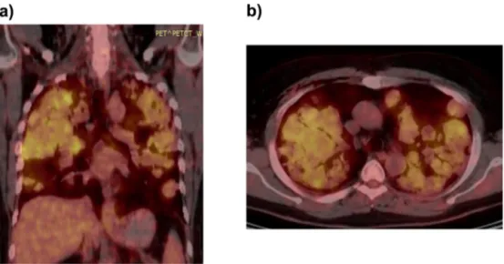 Fig. 5. Axial (a) and coronal-fused PET/CT (b) images. Bilateral lung metastasis demonstrated high-FDG uptake.