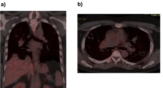 Fig. 7. PET/CT imaging of the lung at 24 months. (a, b) PET/CT imaging at 24 months demonstrating signiﬁcant FDG uptake in residual ﬁbronodular densities in the lung (complete metabolic response).