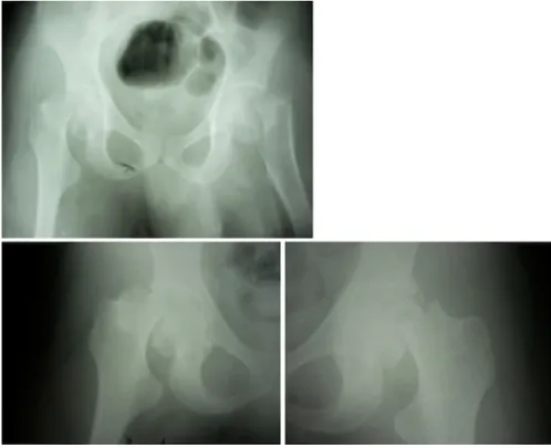 Fig. 1. Preoperative anteroposterior radiographs of both hips.