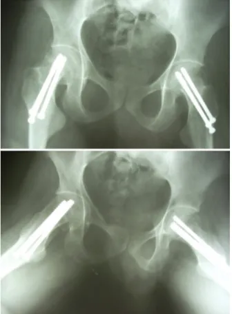 Fig. 3. Anteroposterior radiographs of both hips 15 months postoperatively.