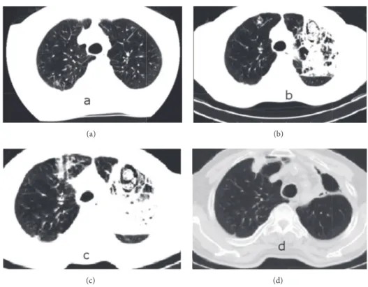Figure 1: Chest tomography views on 4th day (a), 18th day (b and c), and 6th month (d) of hospitalization.