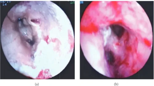 Figure 2: The appearance of the left main bronchus in the bronchoscopic examination performed before (a) and after (b) the 15th day of voriconazole treatment.