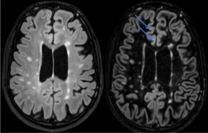 Figure  1.  Axial  FLAIR  (left)  and  DIR  (right)  sequences;  the  intracortical  lesions  (arrows)  seen  on  the  DIR  sequence  are  not  visualized on the FLAIR sequence