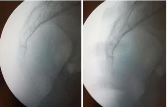 Fig. 1    A hypermobile coccyx flexes more than 25° after application of force