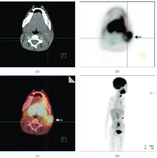 Figure 3: Positron emission tomography (PET)/CT with ﬂourdeoxyglucose (FDG) showing an increased activity of SUVmax: 8, 26 in left parotid gland’s posterior side, without distant metastases.