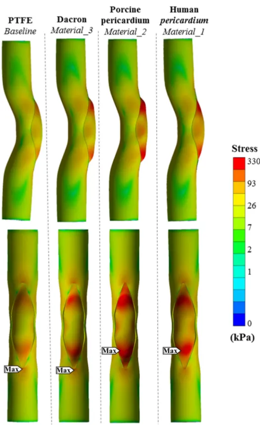 FIGURE 6. Equivalent stress distributions after patch reconstruction corresponding to the acute post-operative state, for different patch materials