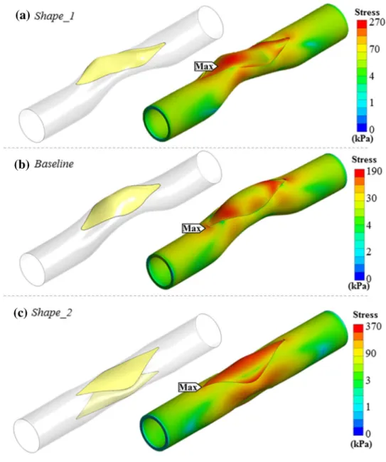 FIGURE 4. Exploring novel surgical options in main pulmonary artery patch surgery using the proposed simulation framework.