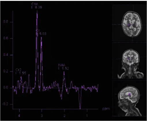 Fig. 3 e Decreased NAA and lactate peak (1.3 ppm), on TE 135 single voxel MR spectroscopy image, are consistent with neuronal loss in the right thalamus.
