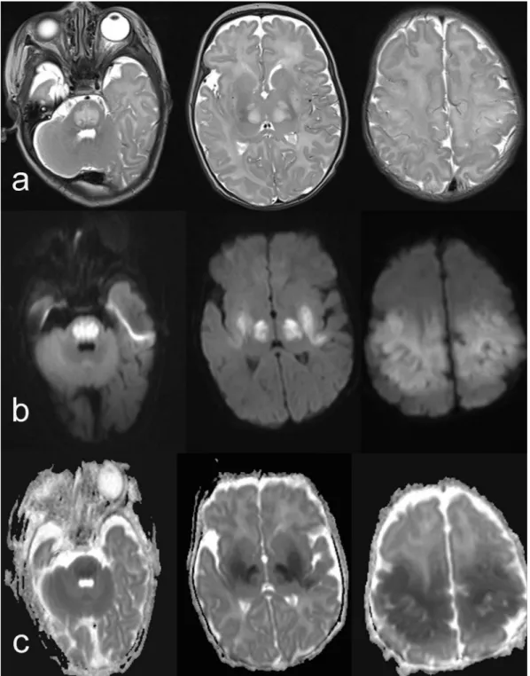 Fig. 4 e Axial T2-weighted MR images (a) show increased signal intensity in pons, medial thalami, putamina, frontal and, parietal lobes