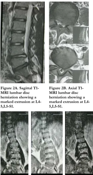 Figure 1A. Sagittal  T2-MRI  lumbar disc  herniation showing a  marked extrusion at  L2–3