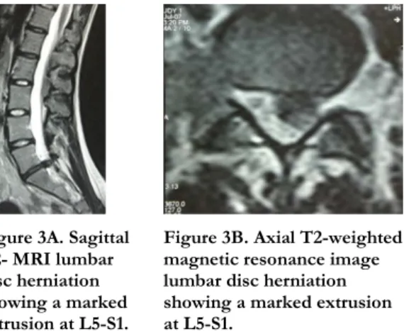 Figure 3A. Sagittal  T2- MRI lumbar  disc herniation  showing a marked  extrusion at L5-S1.