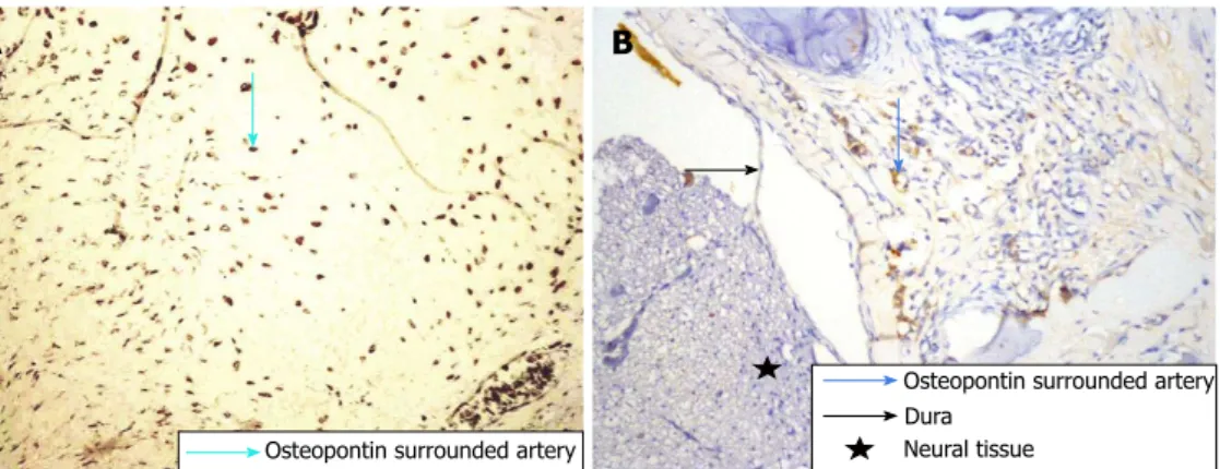 Figure 4  Immunohistochemical tissue section stained with anti-osteopontin antibody. A: Grade-3 fibrosis in Group  Ⅰ ; B: Grade-1 fibrosis in Group  Ⅱ 