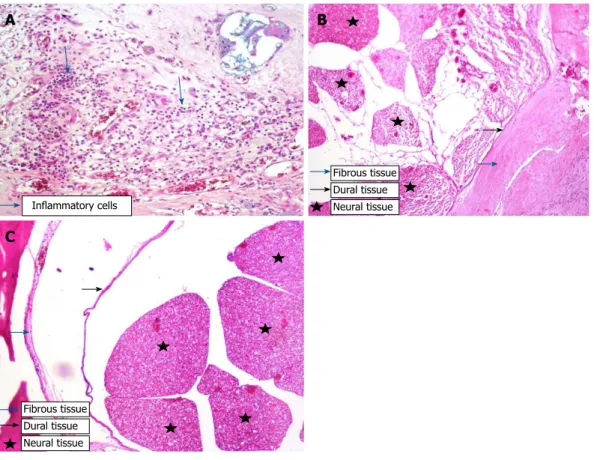 Figure 2  Histopathological tissue section stained by HE. A:  Grade-3 fibrosis and inflammatory cells in Group I; B: Grade-3 fibrosis and fibrous tissue in Group I; C: 
