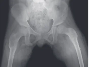 Figure 2. Postoperative radiograph of a patient after bilateral  femoral varus derotation osteotomy and Dega transiliac  osteotomy.