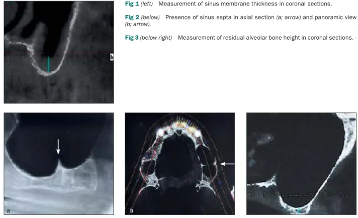 Fig 1 (left)  Measurement of sinus membrane thickness in coronal sections. 