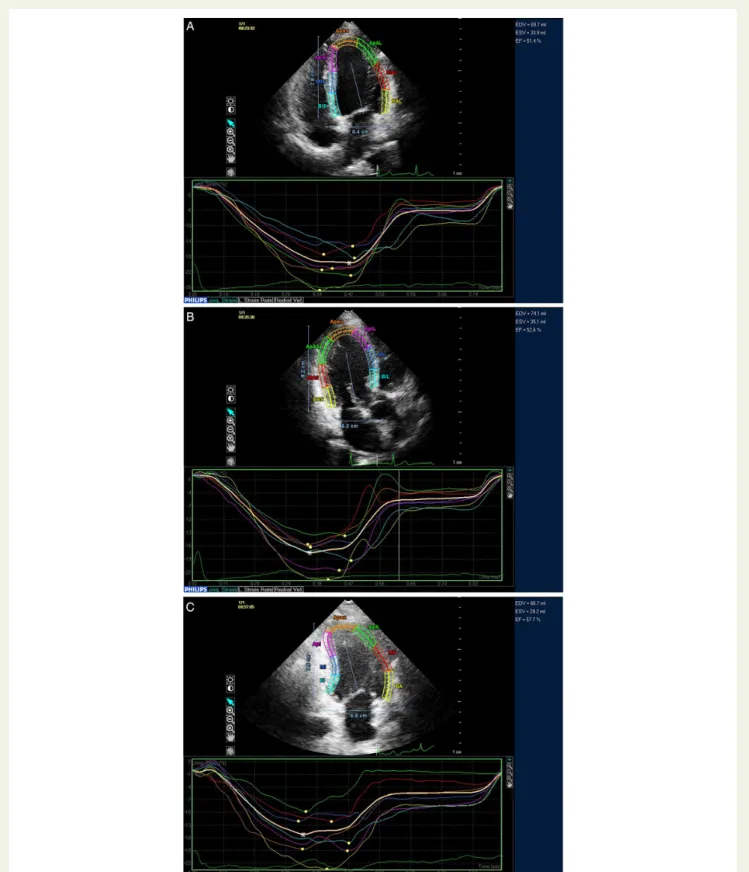 Figure 1 GLS measurement. The asterisk in (A) shows the average of peak strain values obtained from apical four-chamber view segments