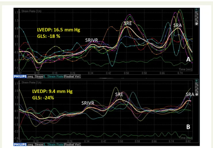 Figure 3 Comparison of SR curves from an index patient with elevated LV end-diastolic pressure (A) and from a patient with normal filling pres-