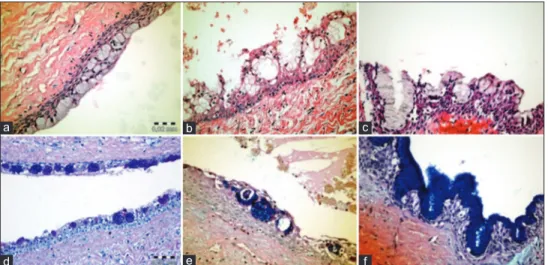 Figure 5: Epithelial lining showed plaque-like thickenings into the cyst  wall. Epithelial cells assumed a swirled appearance (stars)