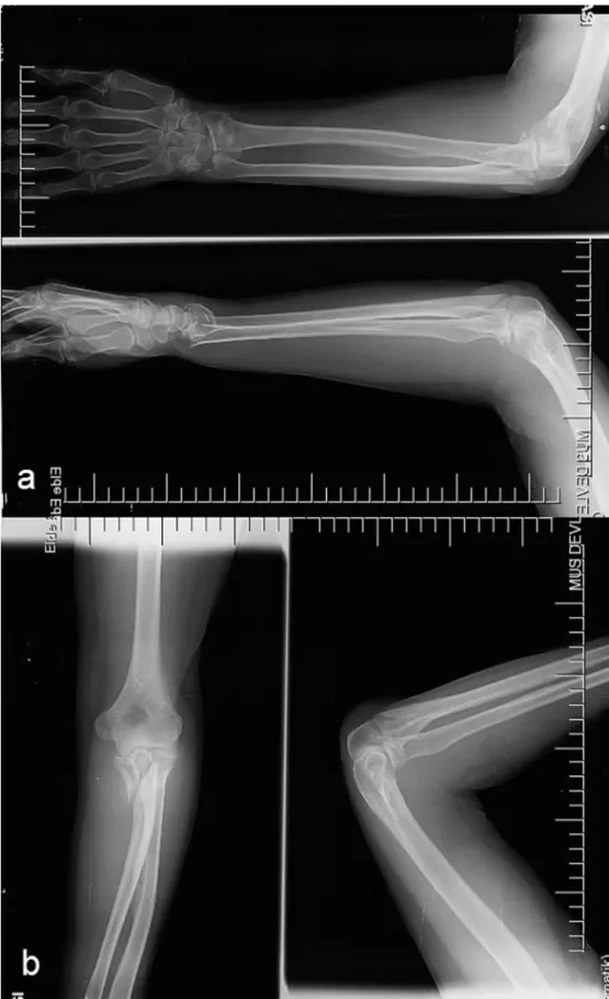 Fig. 1. Preoperative radiological assessment of the patient, AP – lateral radiograph of the elbow (a) and wrist (b).
