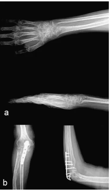 Fig. 2. At 3 months control; radiological assessment of the patient, AP – lateral radiograph of the elbow (a) and wrist (b).
