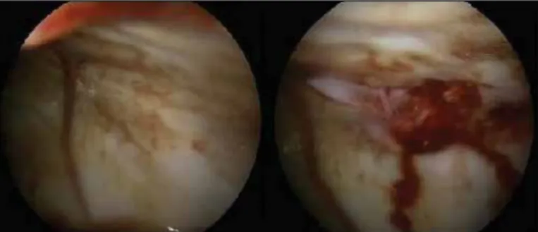 Figure 1. Thoracoscopic appearance of the patient whose blind  pleural biopsy was reported as atypical glandular cells with a  suspi-cion of malignancy