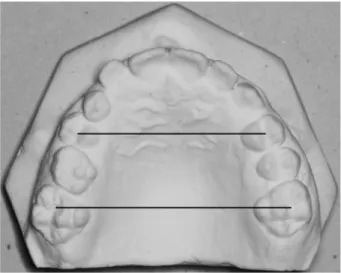 Figure 4  Alveolar width assessment. Maxillary first molar alveolar width: 