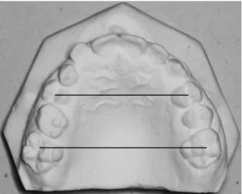 Figure 4  Alveolar width assessment. Maxillary first molar alveolar width: 