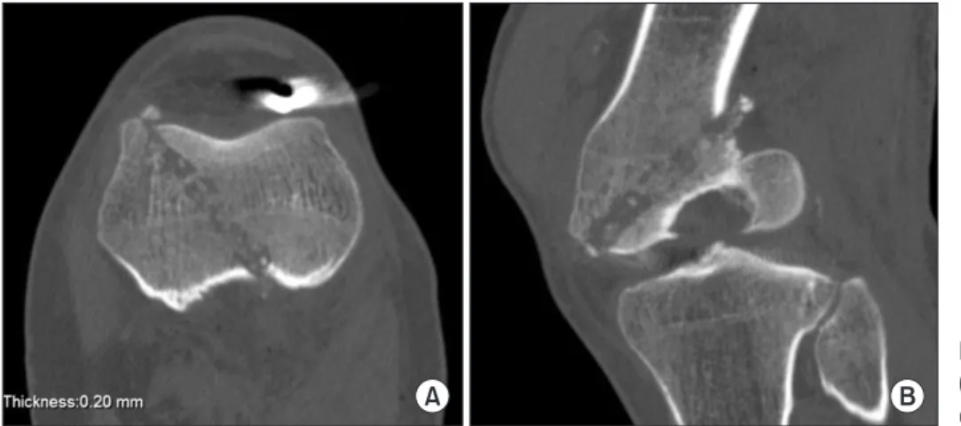 Fig. 3. Arthroscopic view of the bullet in the knee joint in relation to the   intercondylar notch.