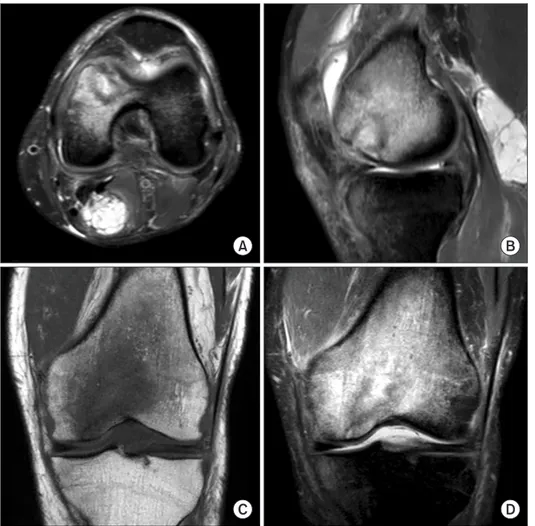 Fig. 4. Postoperative axial (A) and sagi ttal  (B) PD SPAIR, coronal T1 turbo spin echo  (C), and coronal PD SPAIR (D) images