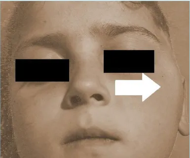 Figure 1. Picture showing the patient with swelling in the  zygomatic region (arrow)