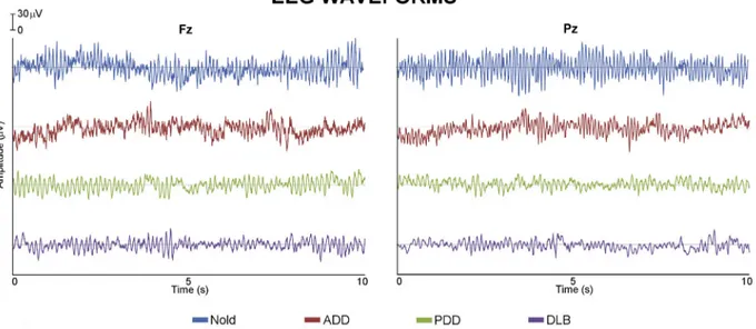 Fig. 1. Representative EEG waveforms (10 seconds) on Fz and Pz scalp electrodes for Nold, ADD, PDD, and DLB participants