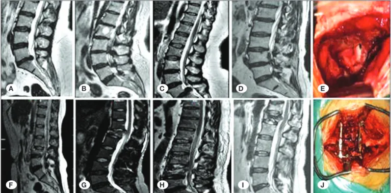 Figure 1: A) T2-weighted sagittal MRI shows L5-S1 subligamentous lumbar disc protrusion