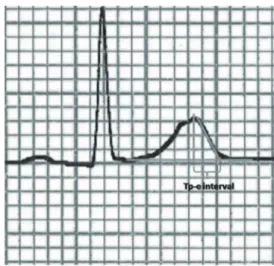 Fig. 1. Measurement of peak and the end of the T wave (Tp-e) in- in-terval.