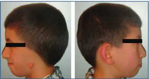 Figure 2: Lack of development of the internal and external ear with related hearing problems and severe mandibular hypoplasia with retrognathia.