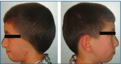 Figure 2: Lack of development of the internal and external ear with related hearing problems and severe mandibular hypoplasia with retrognathia.