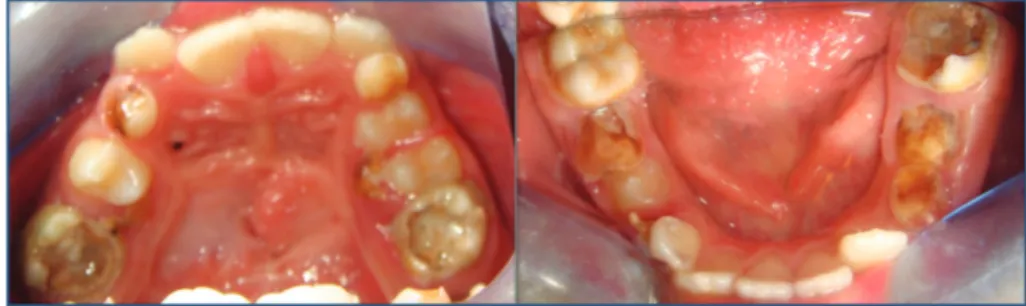 Figure 4: In intraoral findings, numerous carious teeth (#16, #55, #53, #26, #65, #63, #36, #75, #74, #46, #85, #84, and #83), hypomineralisation (#16, #26, #36, and #46), and cleft palate were seen.