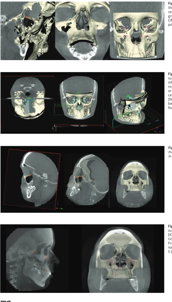 Fig.  1  -  General  layout  of  the  Max- Max-ilim®  software  showing  hard-tissue  segmentation  together  with   radio-graphic slices in sagittal and coronal  CBCT views together with  superim-position of 3D skull representations.