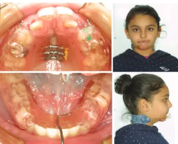 Figure 1  Intraoral and extraoral photographs of mini maxillary protrac- protrac-tor used in the study.