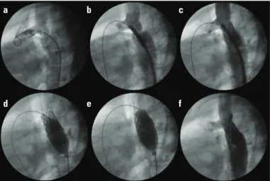 Figure 1. Angiogram of a patient with a mild to moderate coarctation  and large PDA (a); a 34-mm covered stent mounted on a 16-mm balloon  was advanced across the coarctation segment (b) and then implanted  (c); however, there was significant shunt through