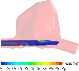 Figure 4a shows the shear stress profile in the cannula body. It is evident from Table 1 that blood