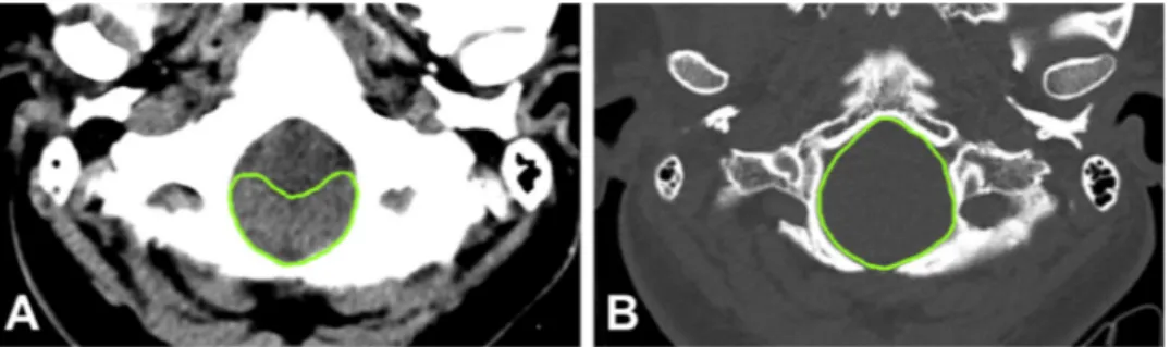 Fig. 2. Radiological measurements and syr- syr-ingomyelia on mid-sagittal T2W MR images
