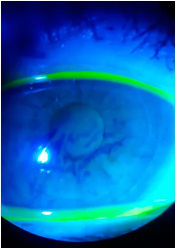 FIG. 1. Tear break-up time showing breaks in the fluorescein after 8 sec on an eye of a patient with vitamin D deficiency.