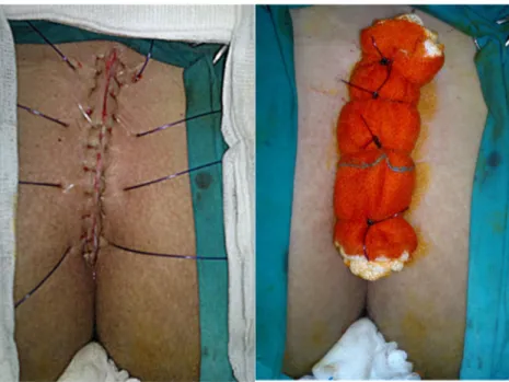 Fig. 3 Closure of the wound and compression dressing tied with retention sutures