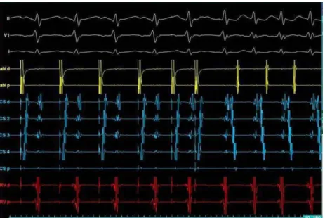 Figure 1. S1 and S2 stimulations from coronary sinus before ablation. VA conduction after pacing is eccentric: the earliest atrial activation is at distal coronary sinus suggesting left posterior AP