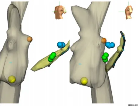 Figure 4. Three-dimensional anatomic mapping showing successful cryoablation sites of AVNRT (yellow lesion) and both APs: left posterior (blue lesions) and left posteroseptal (green lesions)