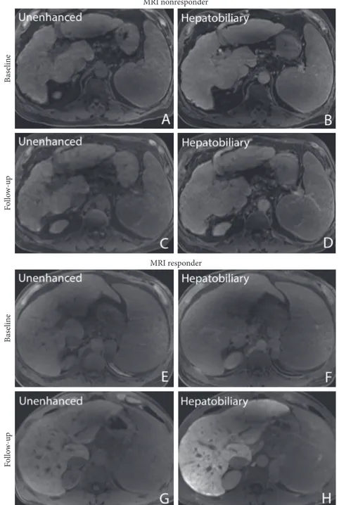 Figure 3: Pre- and posttherapy liver images unenhanced (A, C) and 20 minutes after gadoxetic acid administration in the hep- hep-atobiliary phase (B, D) in a 68-year-old male patient with a decrease in relative liver enhancement (RLE) from 56% to 34%