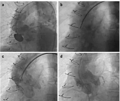 Figure 2. a: Digital subtraction angiographic imaging of the aortic pseu- pseu-doaneurysm