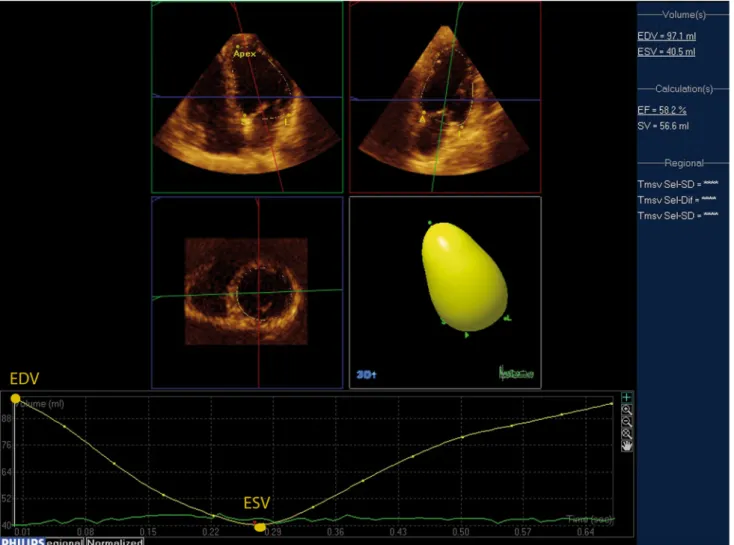 Fig. 2 An example of real-time 3-dimensional echocardiographic quantification of left ventricular volume