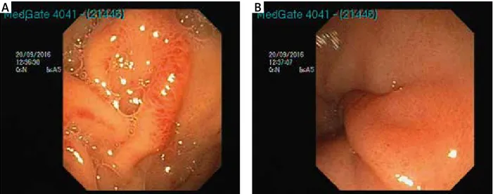 Fig. 1. A) Erosions and edema in antrum of stomach. B) Erythema in antrum of stomach